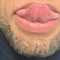 Braklez