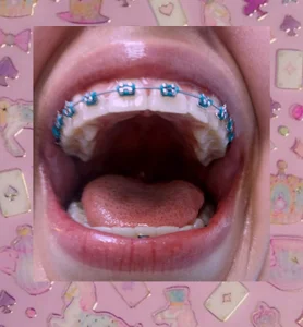 luna_bloomm_ ♡BRACES♡ slika 2