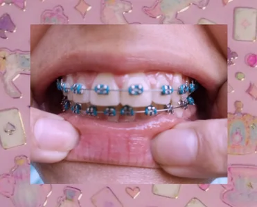 luna_bloomm_ ♡BRACES♡ slika