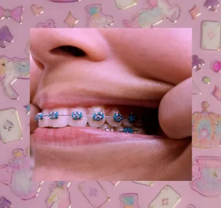 luna_bloomm_ ♡BRACES♡ slika 4