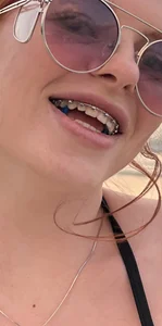 RinaBlondie BRACES TIME Pic