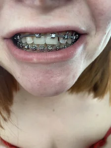 RinaBlondie BRACES TIME Pic 4