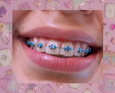 luna_bloomm_ ♡BRACES♡ slika 3